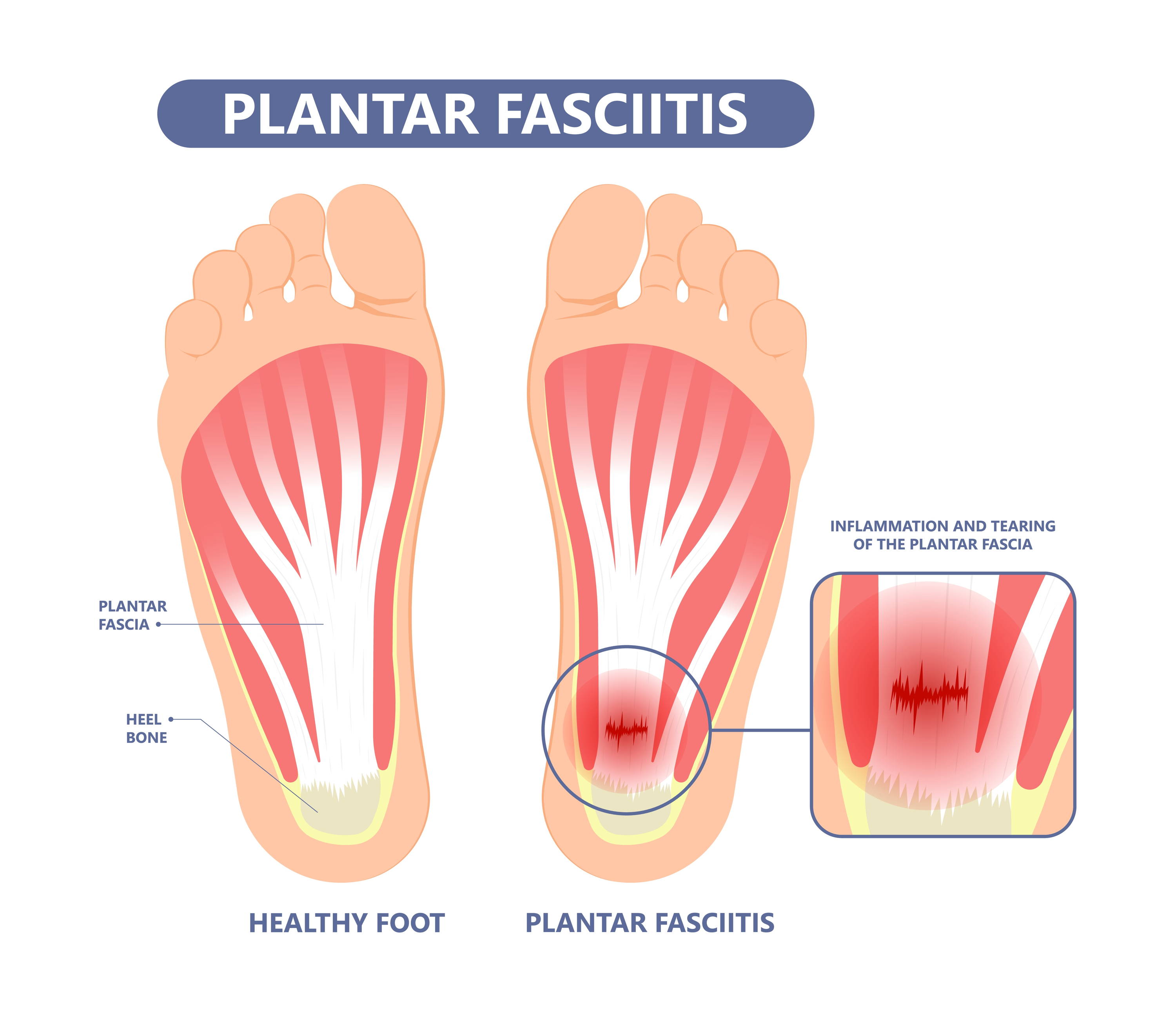 Ask a PT: Plantar Fasciitis – Holabird Sports