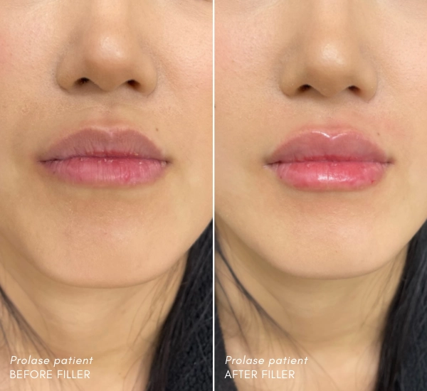 Prolase Patient before and after 0.55ml Volbella Enesae Keshishian RN