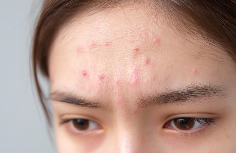 Incorrect 10 skin care routine causing acne breakouts and highlighting the need for personalized Korean skincare and professional facial treatments