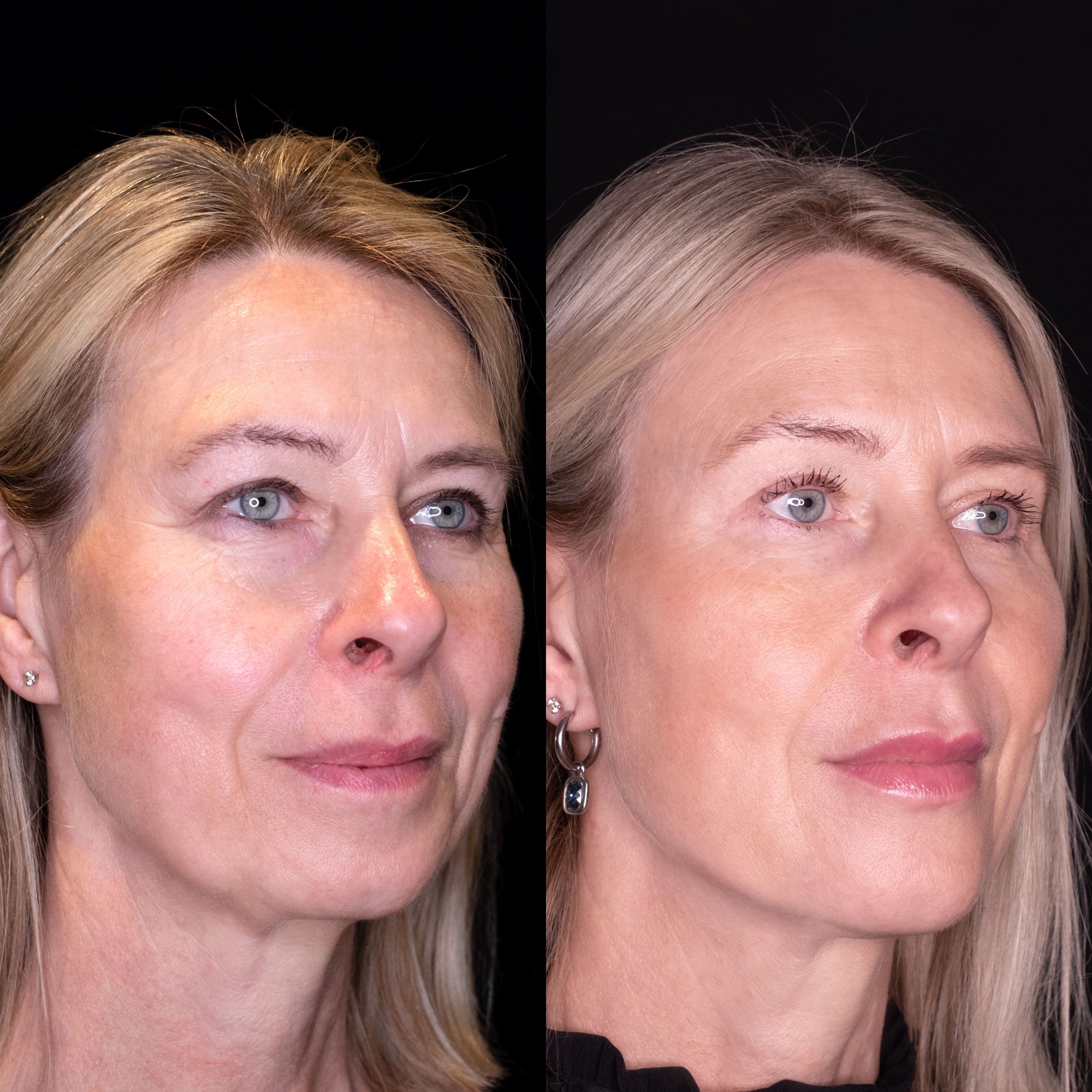 Woman's face before and after a cosmetic procedure, side profile comparison.