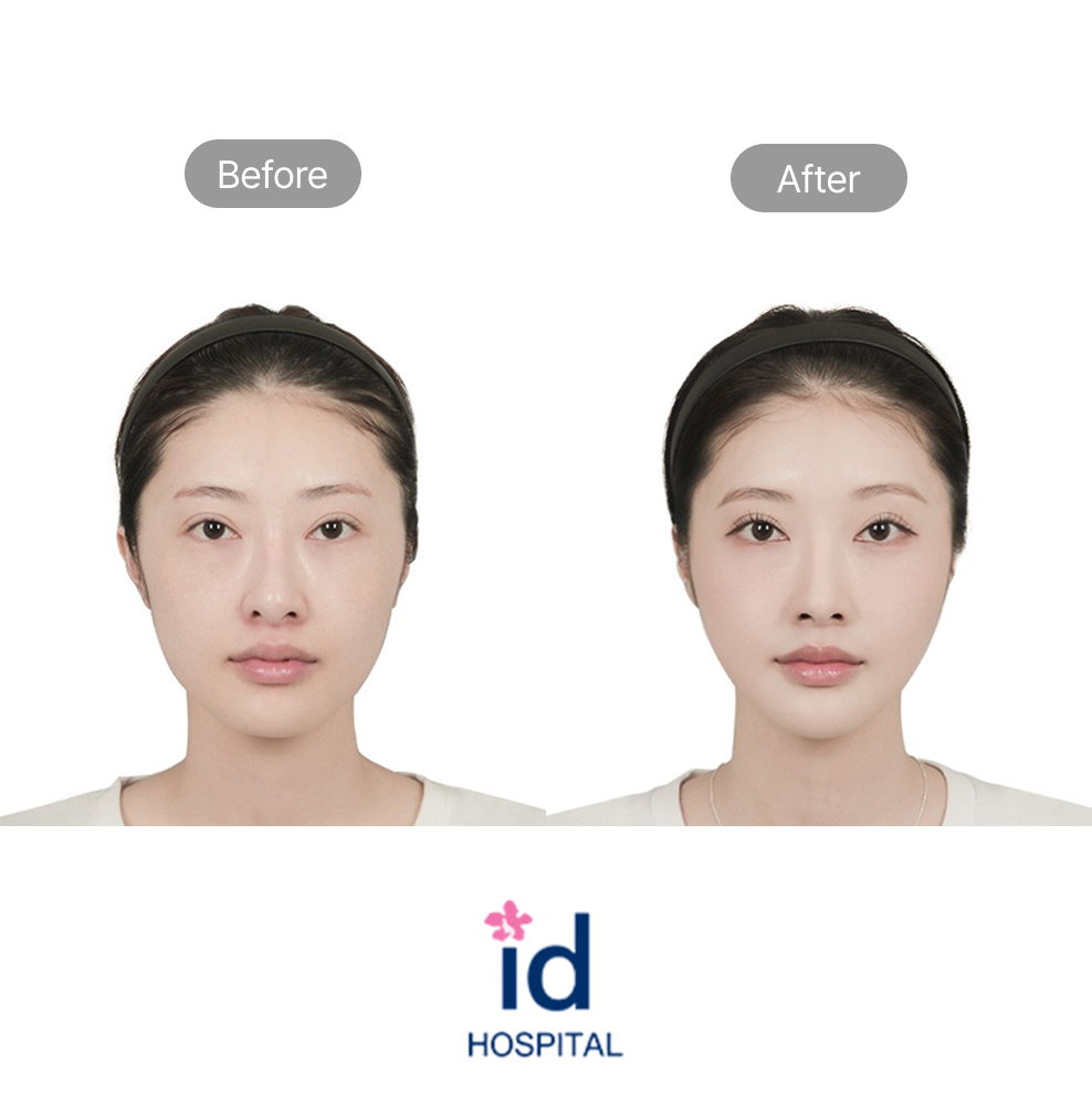 Square Jaw and Chin Surgery Before and After Result at ID Hospital