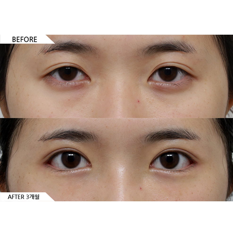 Before and after results of incisional double eyelid surgery, ptosis correction, and canthoplasty showing larger and more defined eye shape in Korea