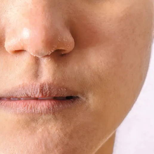 Woman's face with dry, scaly skin peeling off
