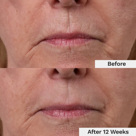 Comparison of a woman's lips before and after 12 weeks of treatment.