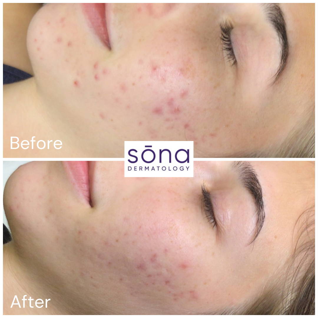 Sona DiamondGlow Facial Before & After 5