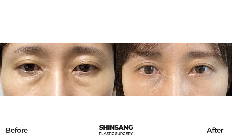 Under Eye Fat Removal And Under Eye Fat Grafting Result At Sinsang Plastic Surgery In Korea