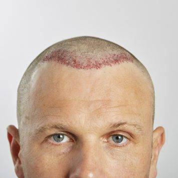 Man After Hair Transplant