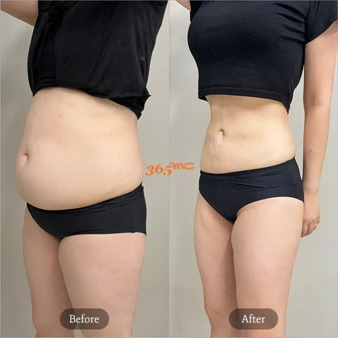 Abdominal Liposuction Body Fat Reduction Before and After Results at 365mc