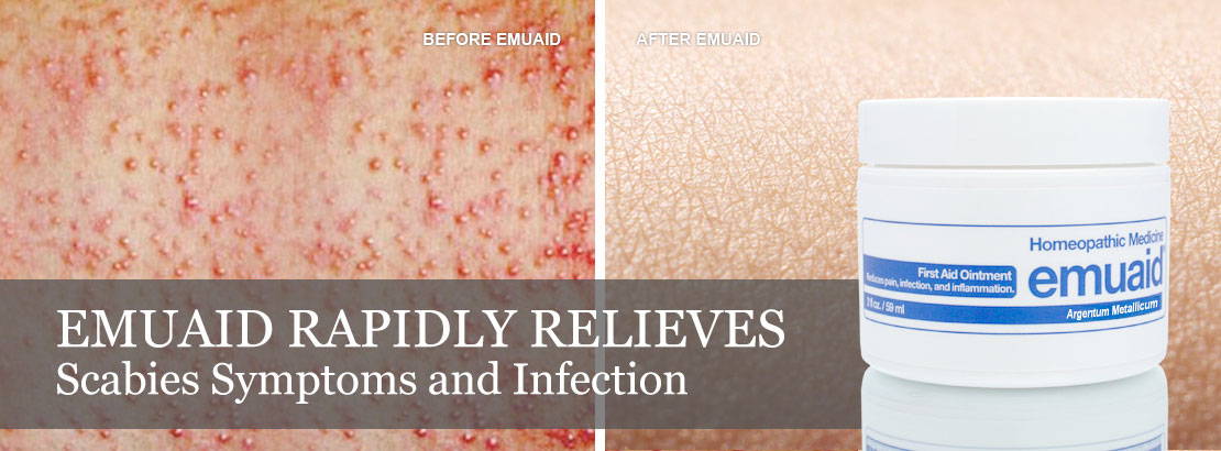 Before and after image of scabies