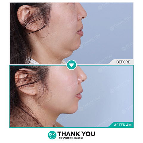 Before and After Face Fat Removal in Plastic Surgery Korea as Part of Face Contouring Surgery