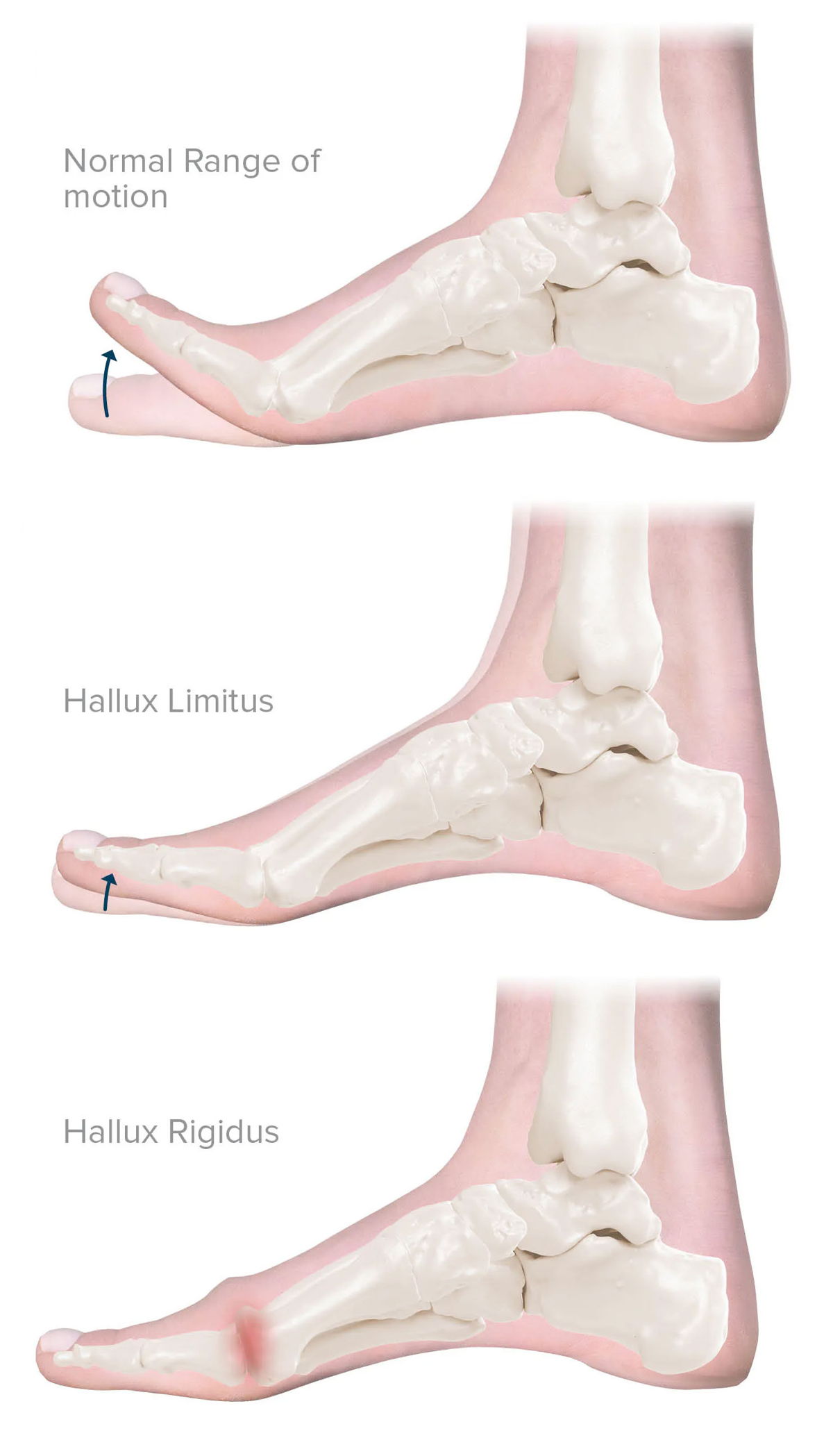 Hallux Rigidus — clinical assessment