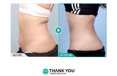 Before And After Review Image Of Abdominal Liposuction At Thank You Plastic Surgery Clinic In Korea