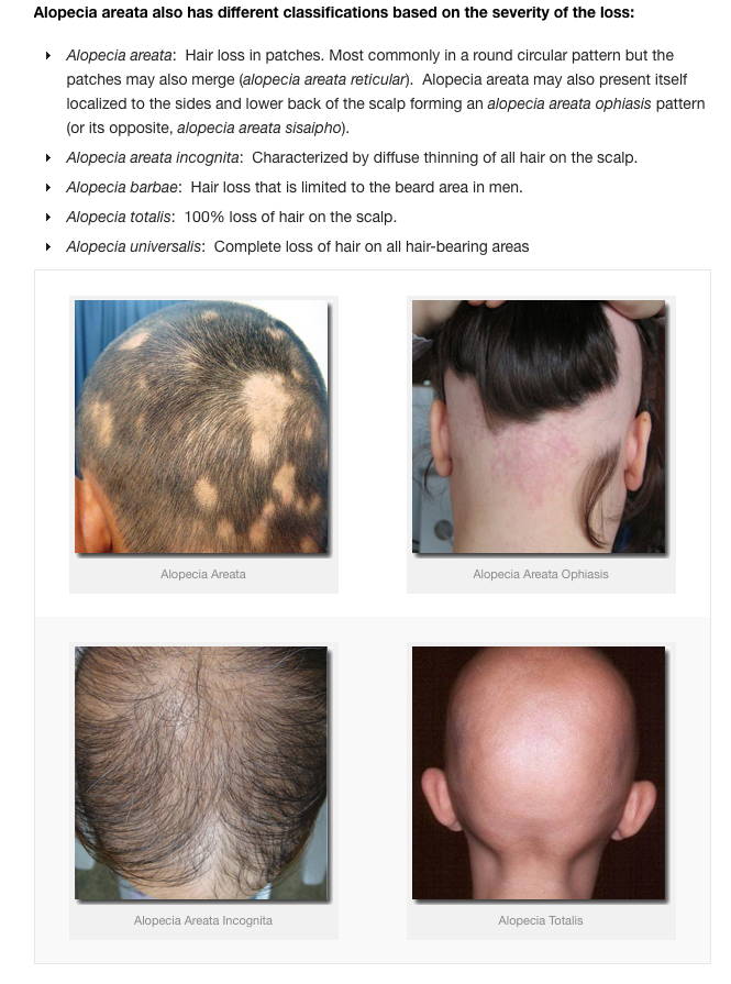 How Do I Know What Type of Alopecia I Have? – DS Healthcare Group