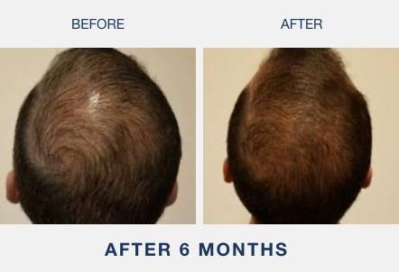 indian mans laser cap results after using an illumiflow product