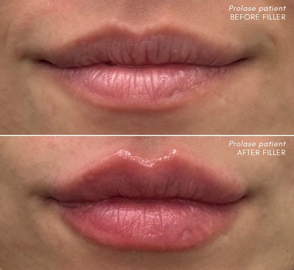 Prolase Patient before and after Juvederm Volbella in lips with Enesae Keshishian RN