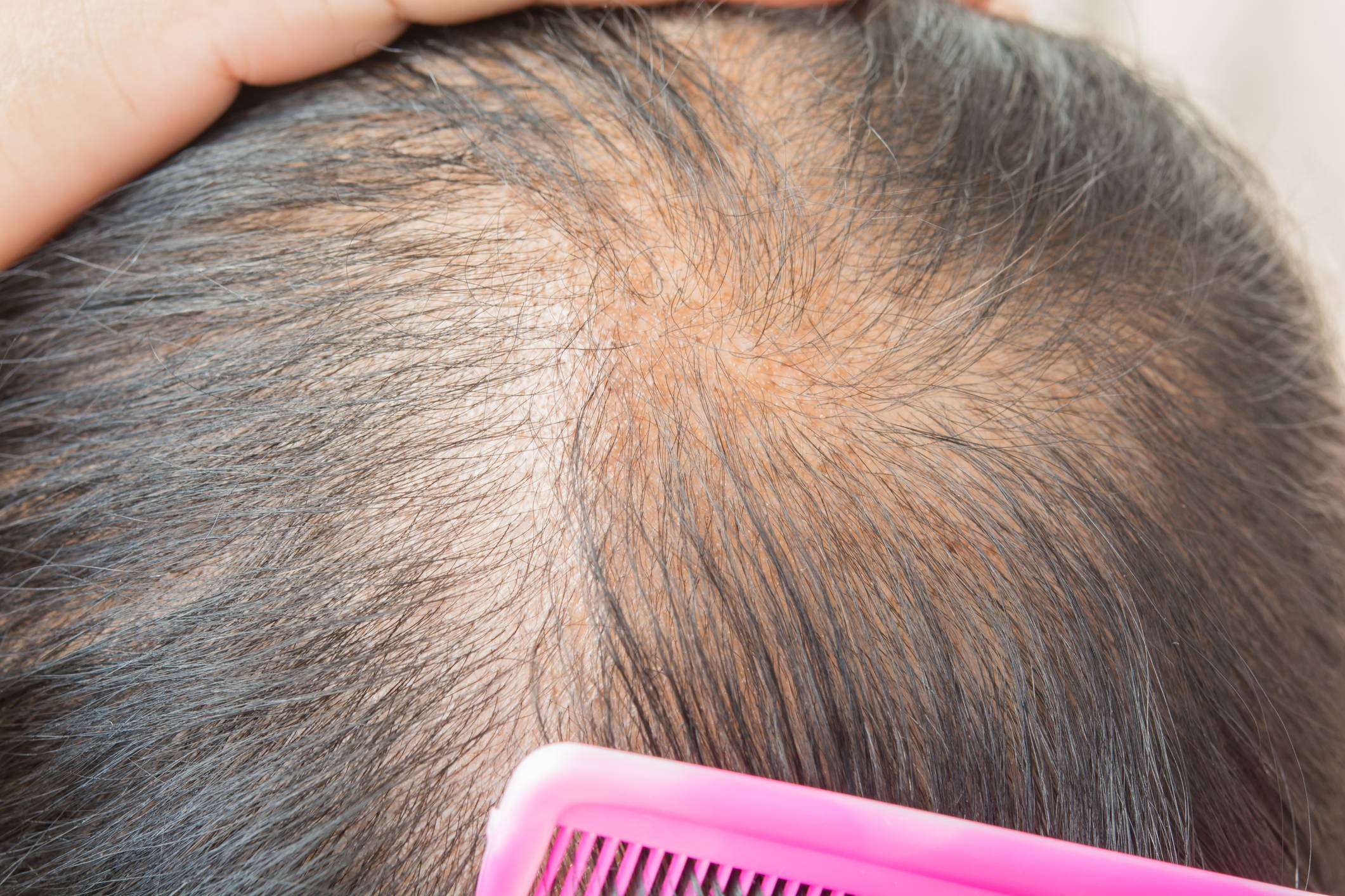 Does Stopping Finasteride Accelerate Hair Loss? – DS Healthcare Group