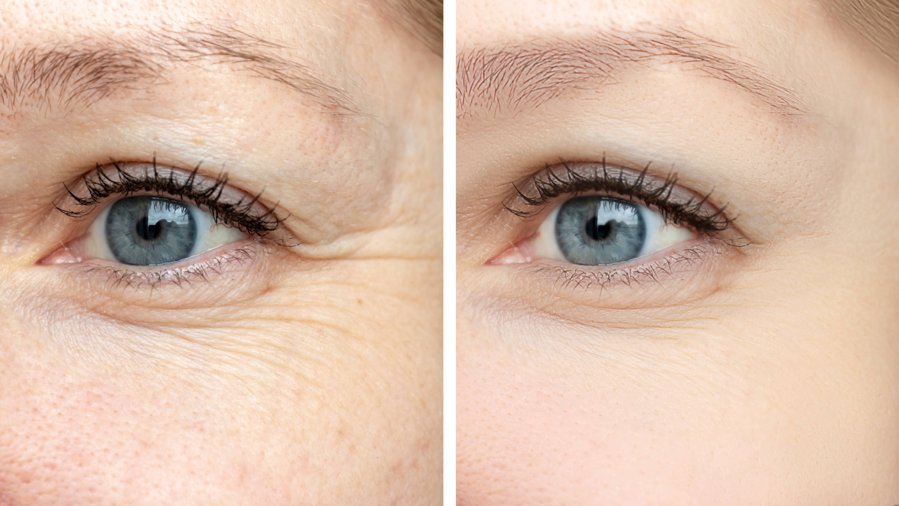 How Hyaluronic Acid Cream Can Improve The Appearance Of Fine Lines