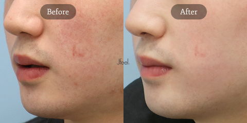 Korean Summer Skin Treatments for Acne Redness and Sensitive Skin with Redness Laser Treatment in Seoul