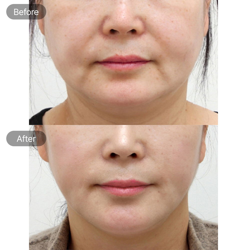 Neck line lifting before and after results for anti-aging facial contour in Korea