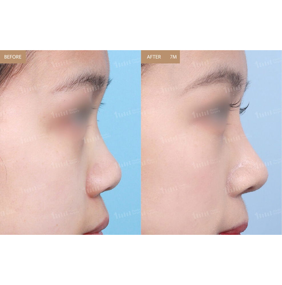 Bulbous Nose Correction and Nose Bridge Rhinoplasty Before and After Results at 1MM Plastic Surgery in Korea