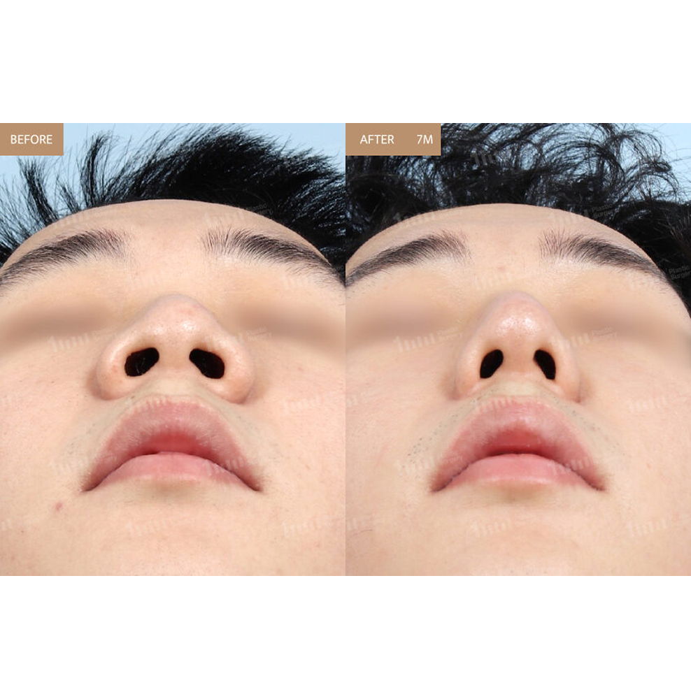 Male Rhinoplasty and Alar Reduction Before and After Results at 1MM Plastic Surgery in Korea