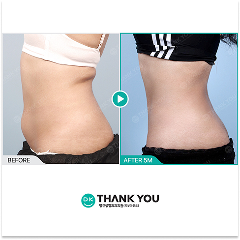 Cryolipolysis Treatment Korea for Non-Surgical Body Contouring and Lower Abdomen Fat Reduction Results