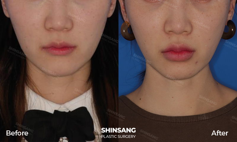 Lip Fillers Lip Enhancement Result At Sinsang Plastic Surgery In Korea