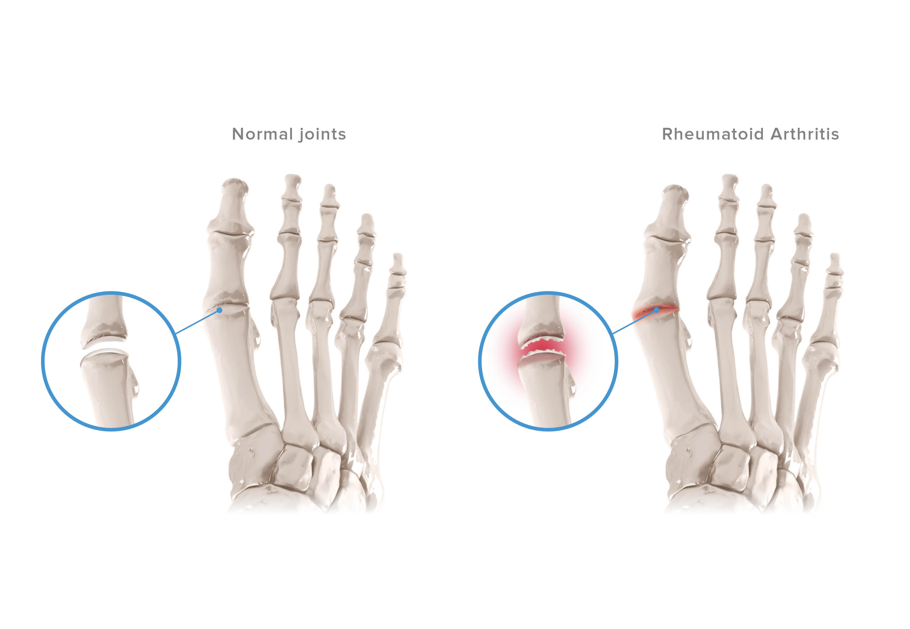 Ankle & Foot Arthritis