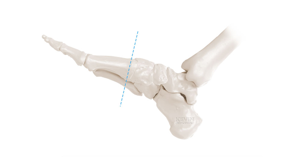 Metatarsocuneiform Joint Excursion – KevinRoot Medical