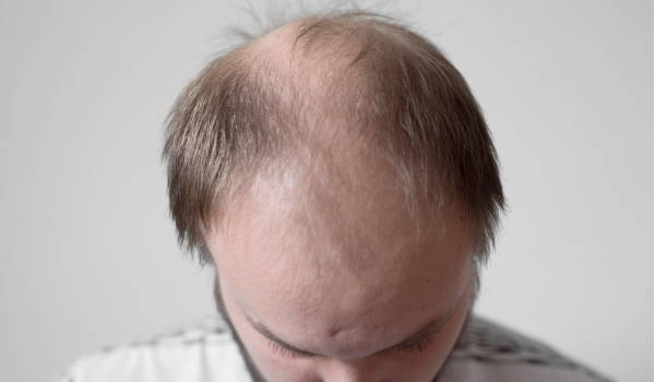 Does Type 2 Diabetes Cause Hair Loss? – DS Healthcare Group