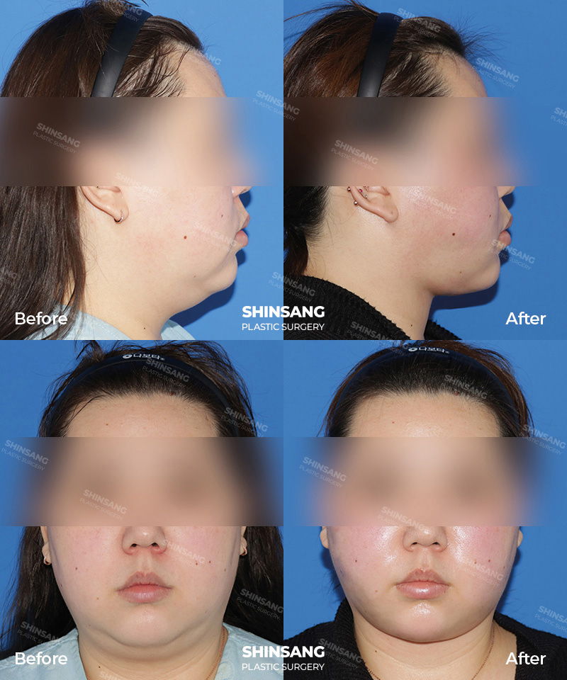 Double Chin Reduction With Chin Fixation Result At Sinsang Plastic Surgery In Korea