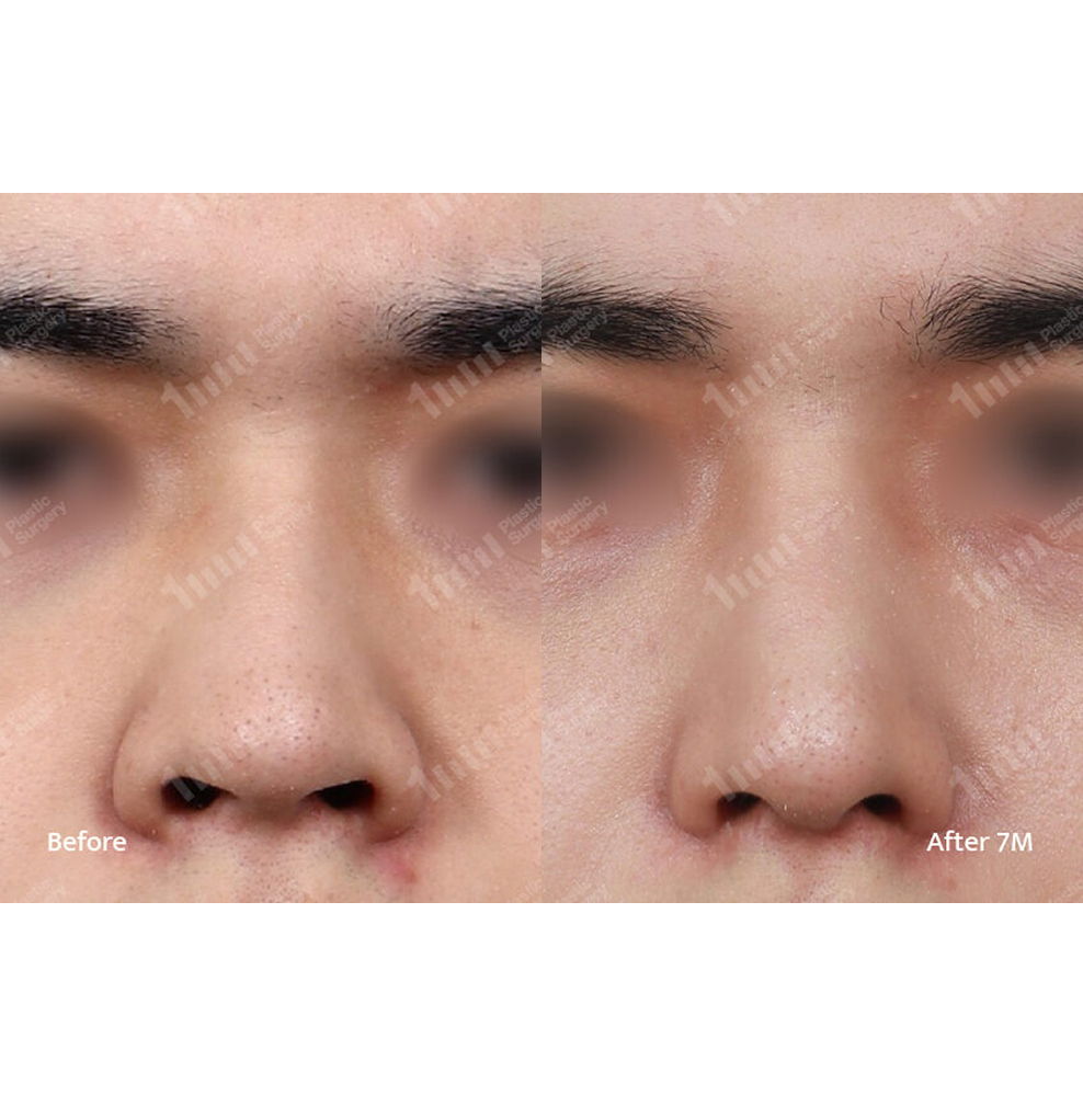 Male Rhinoplasty and Alar Reduction Front View Before and After Results at 1MM Plastic Surgery in Korea