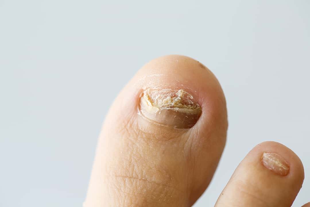 Voici une photo d'une mycose de l'ongle du pied.
