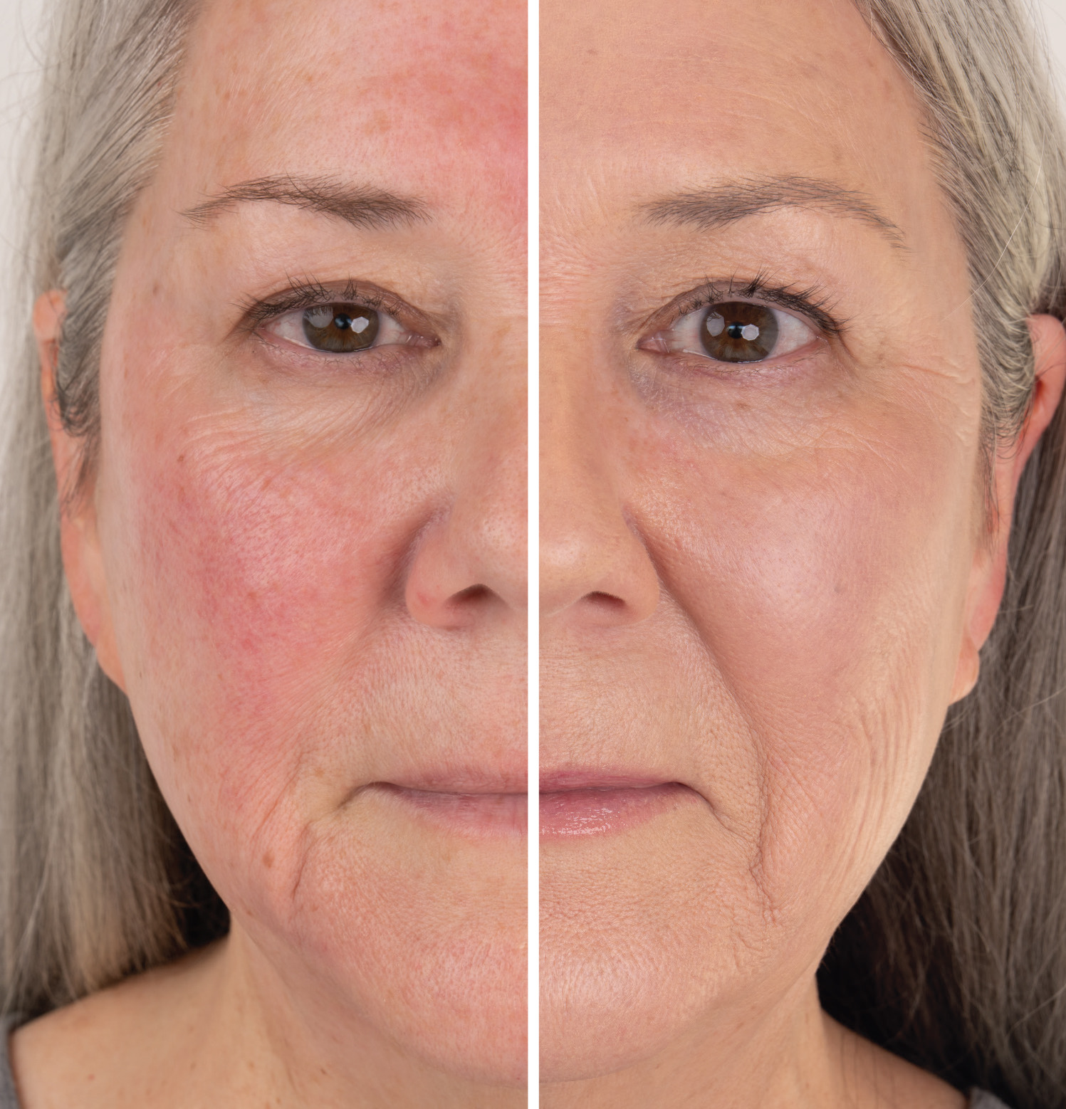 Woman's face showing skin differences before and after treatment.