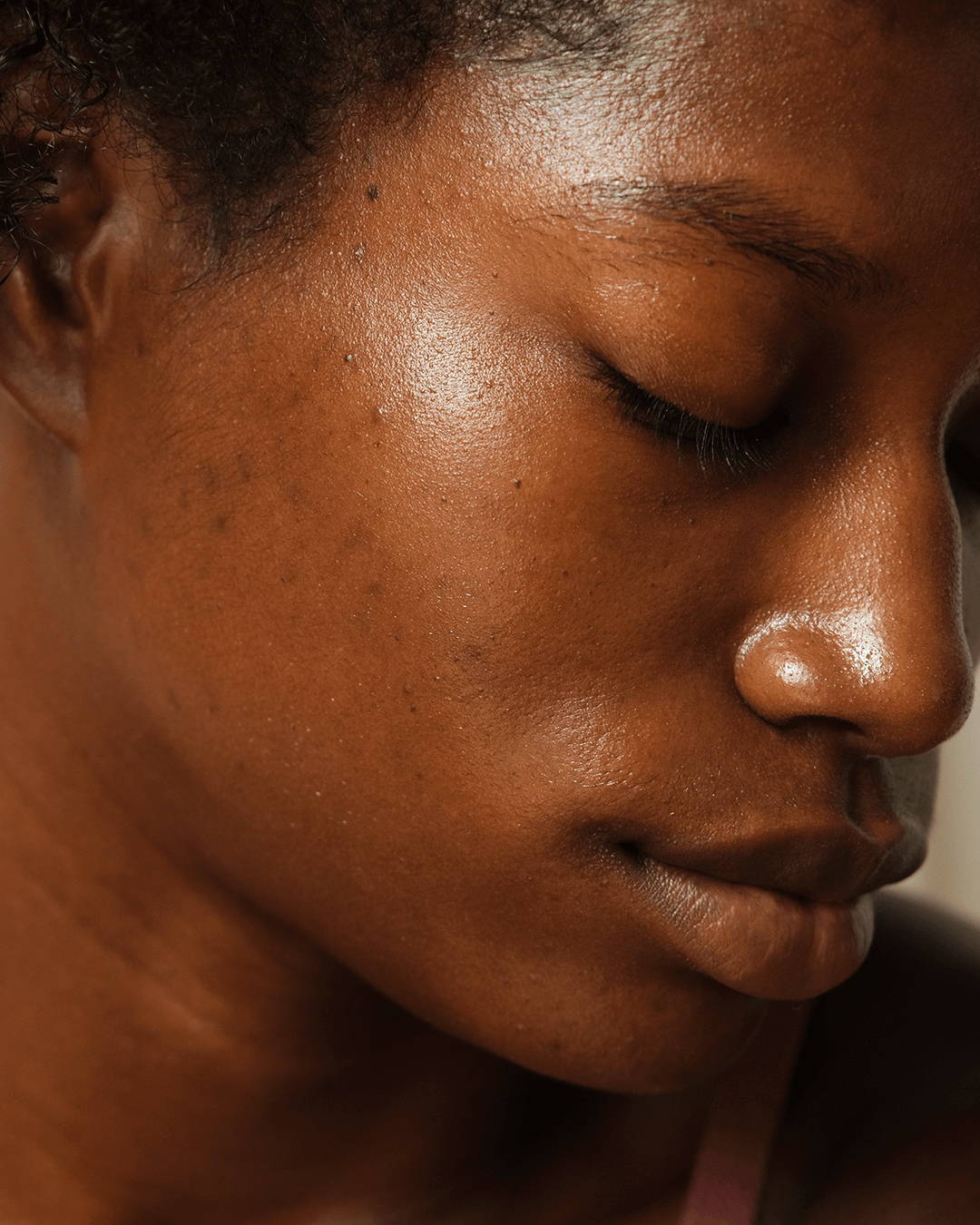 #seo: Blemish-prone skin
