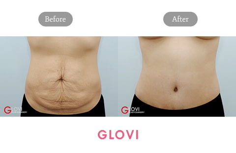 Mommy Makeover Korea Tummy Tuck Before and After Results at Glovi Plastic Surgery Clinic