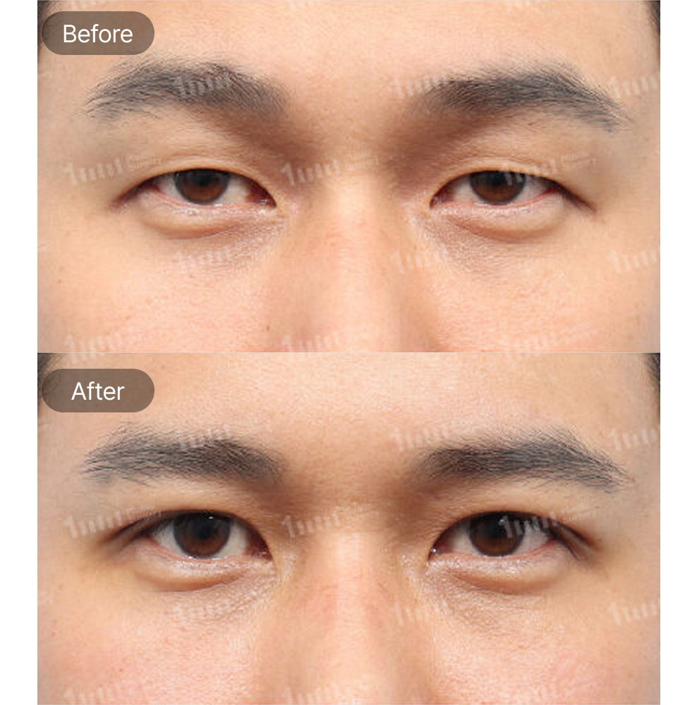 Male Eye Surgery and Ptosis Correction Before and After Results at 1MM Plastic Surgery in Korea