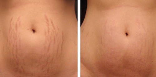 How Dermaroller Before and After Stretch Mark Treatment Works - Rejuviss