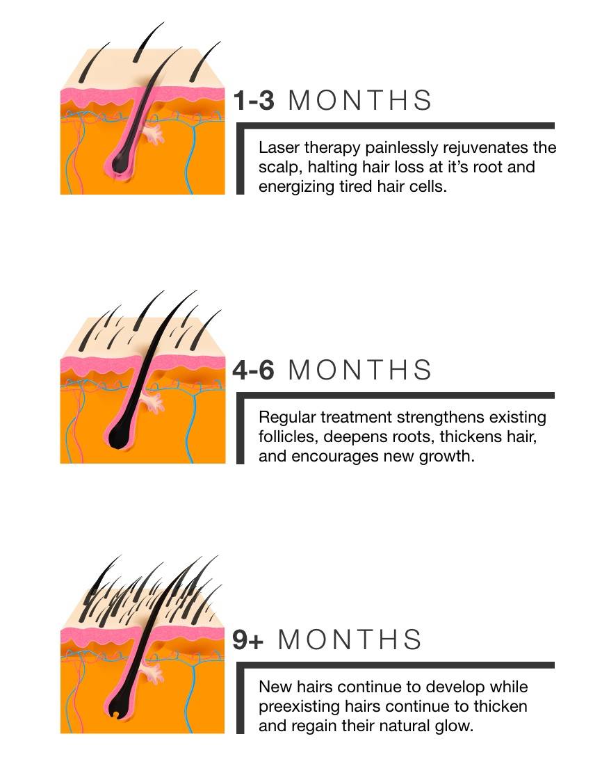 hair regrowth timeline with low level laser therapy