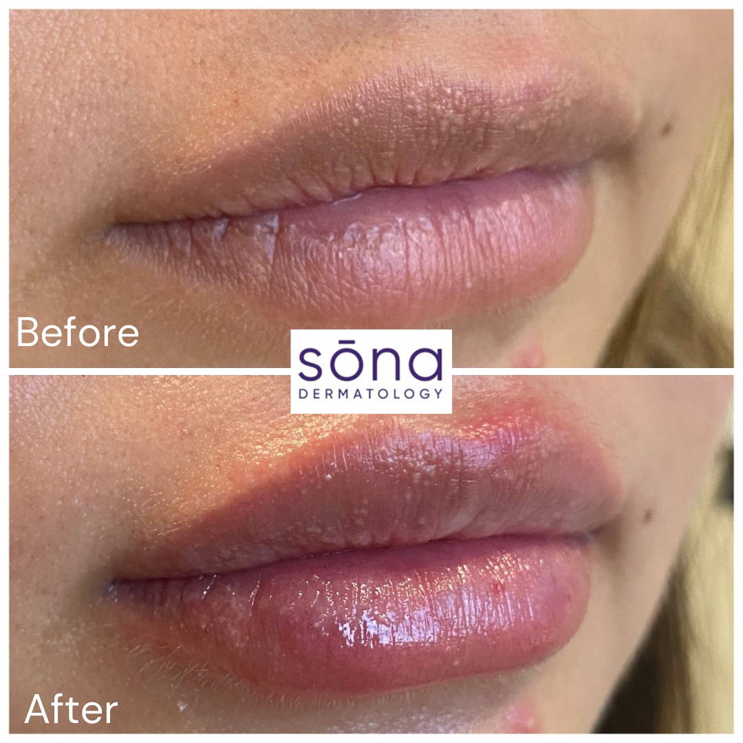 Sona Juvederm Lip Filler Before & After