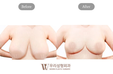 Mommy Makeover Korea Breast Reduction Before and After Results at Woori Plastic Surgery Clinic