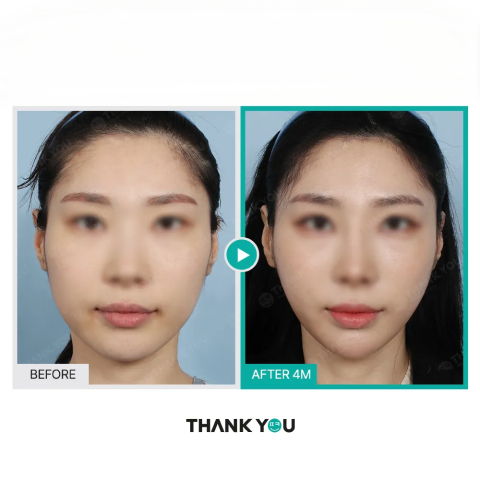 Face Lift Using Threads Before and After 4 Months – Jawline Thread Lift in Korea by Jivaka Beauty