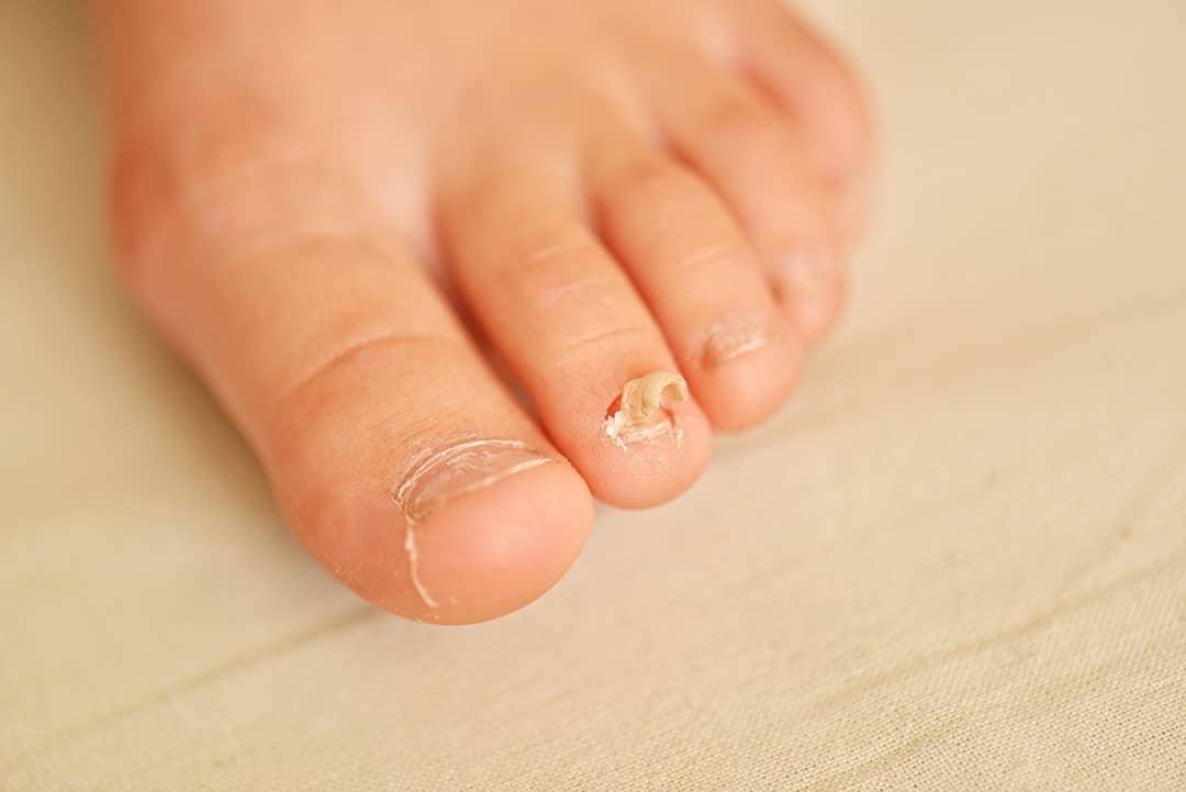 A picture of a foot with cracked toenails