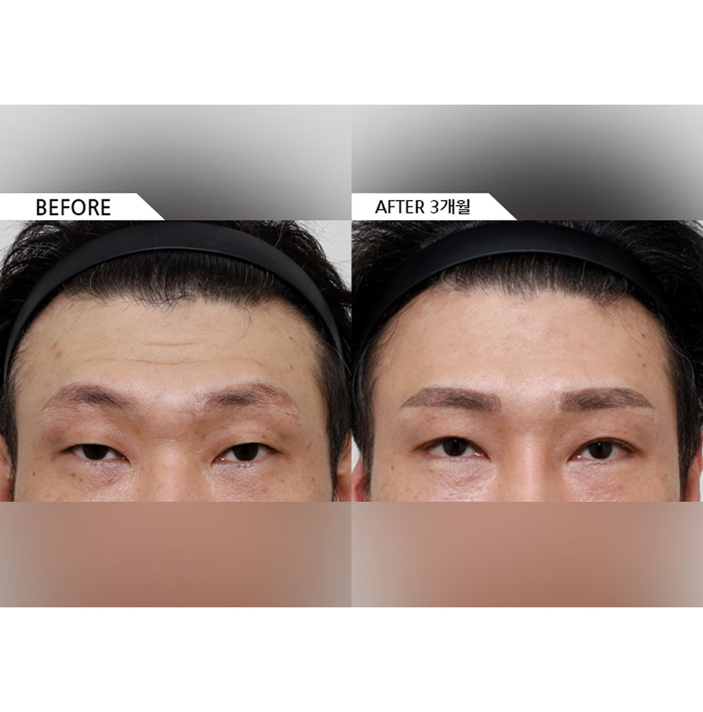 Before and after results of middle-aged eye surgery including forehead lift, double eyelid surgery, ptosis correction, and canthoplasty for brighter and more youthful eyes in Korea