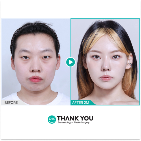 Jawline contouring results in Korea using liposuction, thread lift, and fillers after free online medical consultation with personalized treatment planning