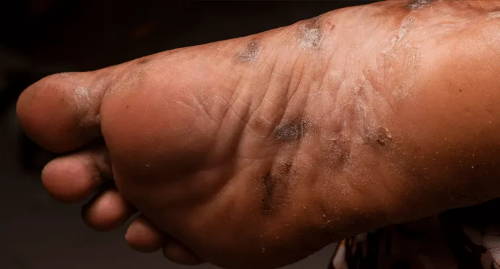 Une personne à la peau foncée présentant une éruption écailleuse violette sur la plante du pied due au psoriasis