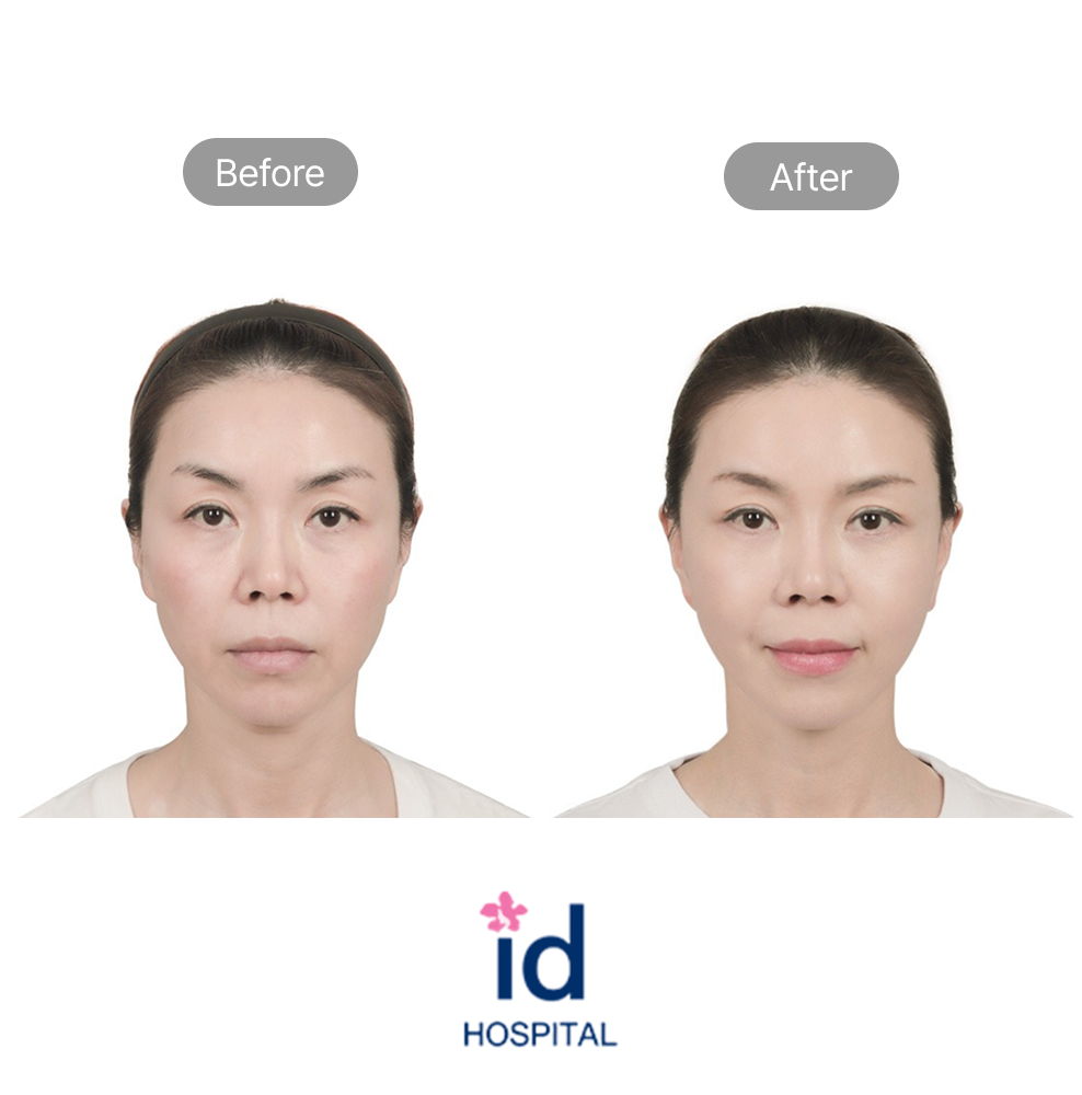 Upper Eyelid Eye Reshaping and Lower Blepharoplasty Before and After Result at ID Hospital