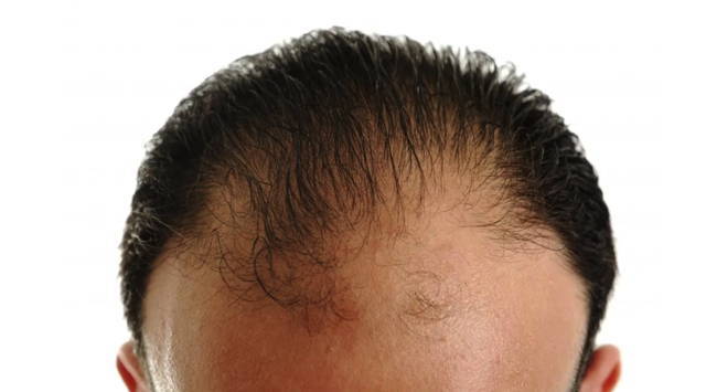 zoom At afsløre Sig til side Does Minoxidil (Rogaine) Work for Frontal Baldness? – DS Healthcare Group