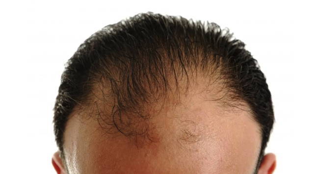 Hykler ækvator mængde af salg Does Minoxidil (Rogaine) Work for Frontal Baldness? – DS Healthcare Group