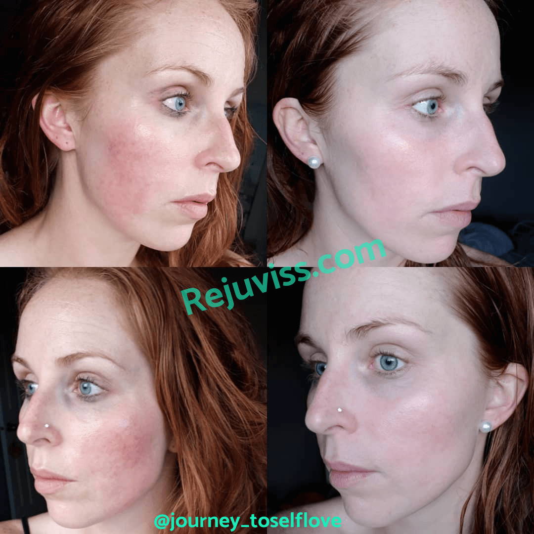 Photo of microneedling before and after 